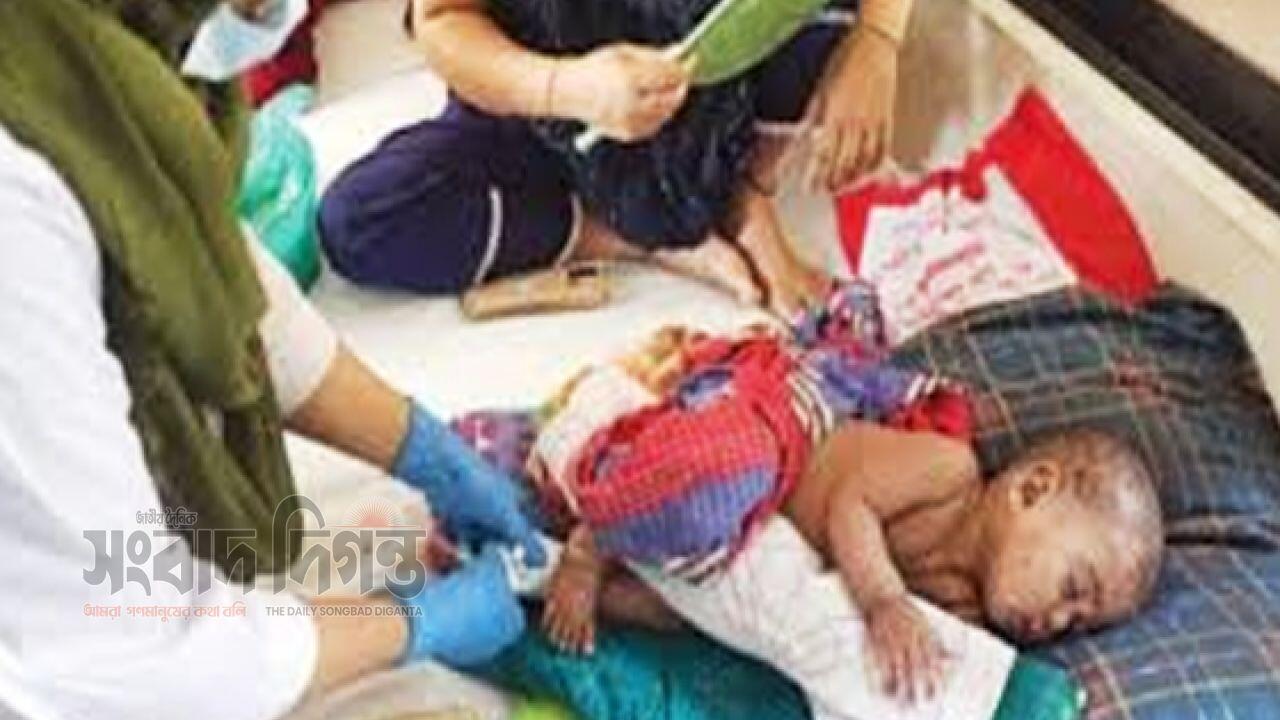 বরিশালে হাম উপসর্গে আরও ২ শিশুর মৃত্যু, মৃত বেড়ে ১৬