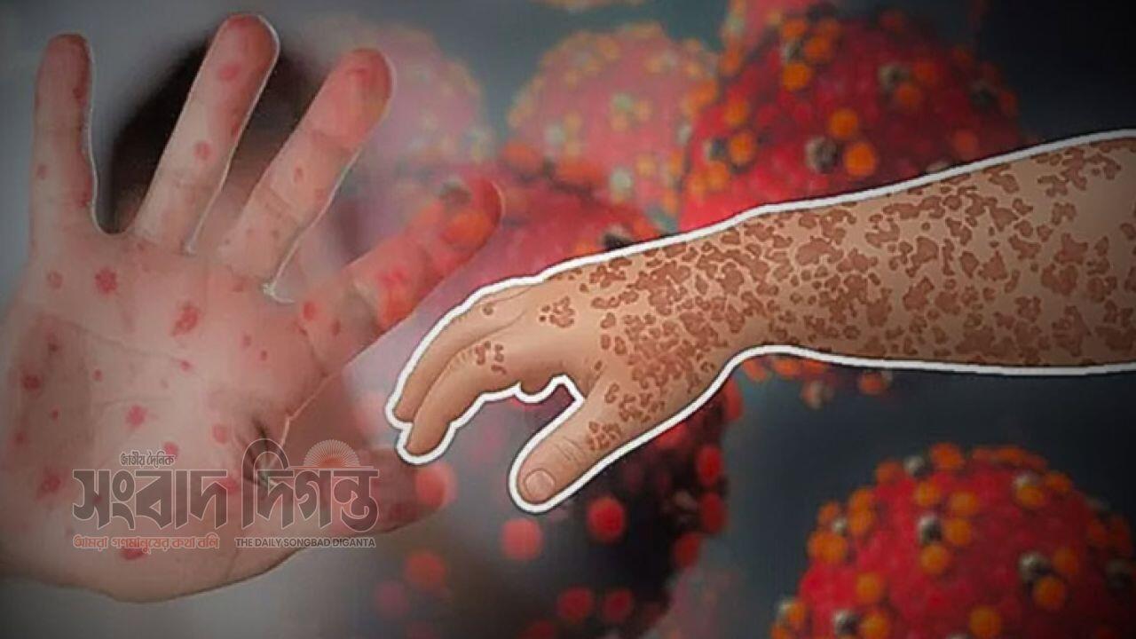 হামের ভয়াবহ বিস্তার: ২৪ ঘণ্টায় আরও ৮ শিশুর মৃত্যু, পরিস্থিতি নিয়ন্ত্রণে চ্যালেঞ্জ