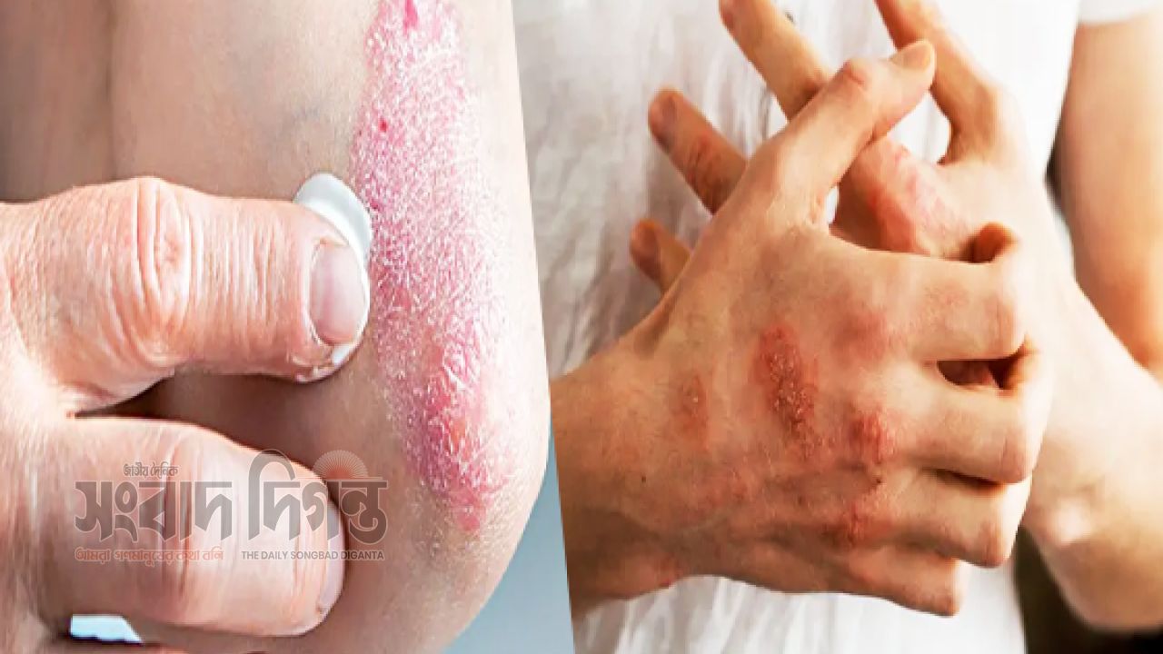 জয়েন্ট ব্যথার পেছনে থাকতে পারে সোরিয়াটিক আর্থ্রাইটিস