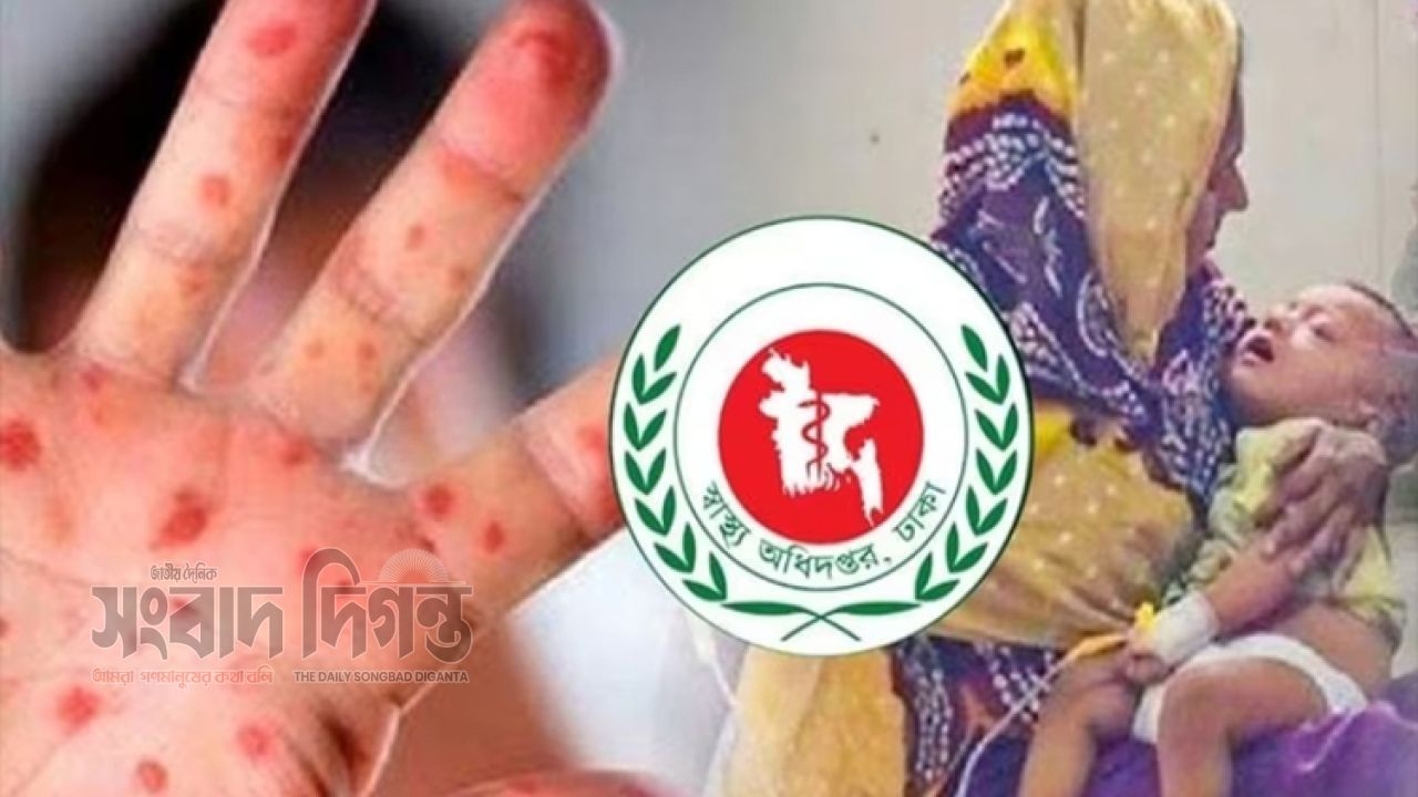 দেশে ২৪ ঘণ্টায় হাম ও উপসর্গে ১০ শিশুর মৃত্যু, নতুন করে ছড়াচ্ছে উদ্বেগ