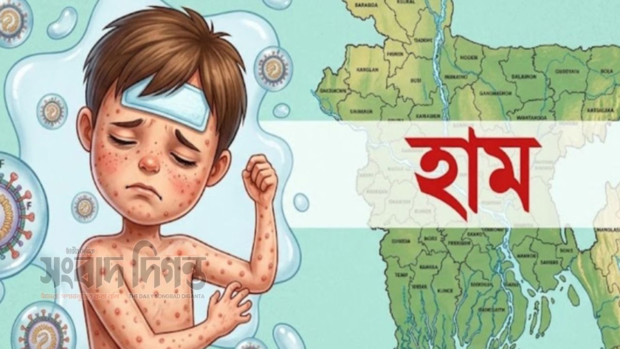 দেশে হাম ও হামের উপসর্গে মৃত্যু বেড়ে ১০৫৩ 