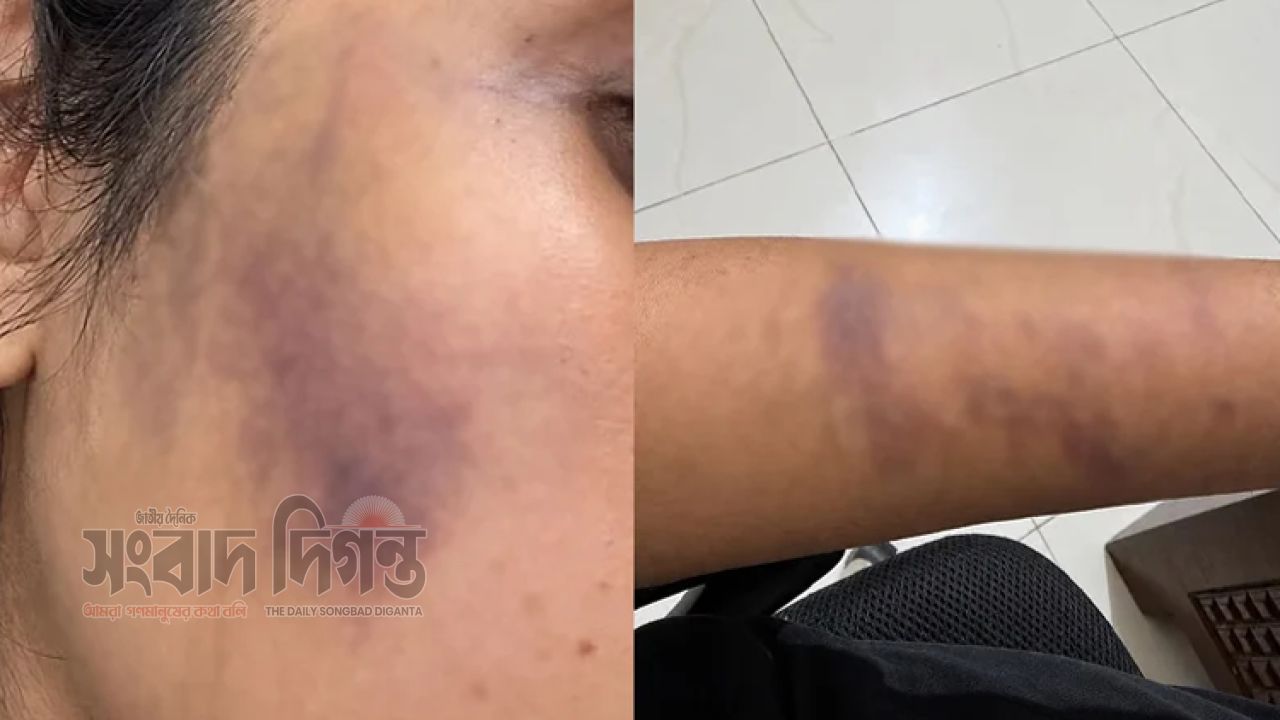 বনশ্রীতে পথকুকুরকে খাবার দেওয়ায় তরুণীকে মারধরের অভিযোগ 